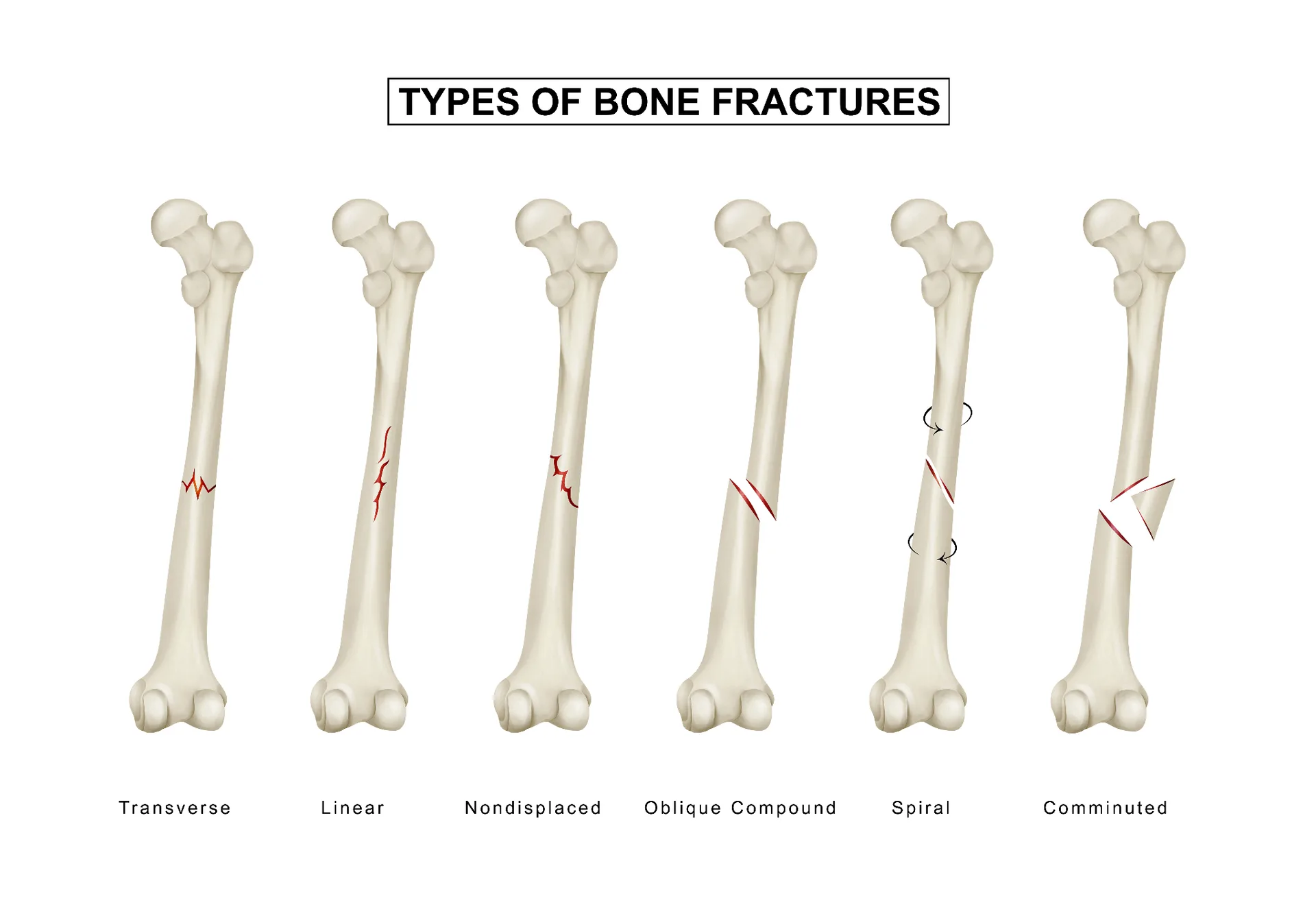 Fracture Surgery In Noida - Types Of Fractures, Surgical Treatment, And Recovery