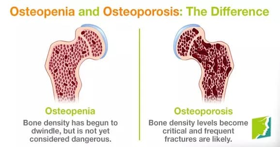 Osteoporosis vs Osteopenia — What's the Difference and What Should You Do?