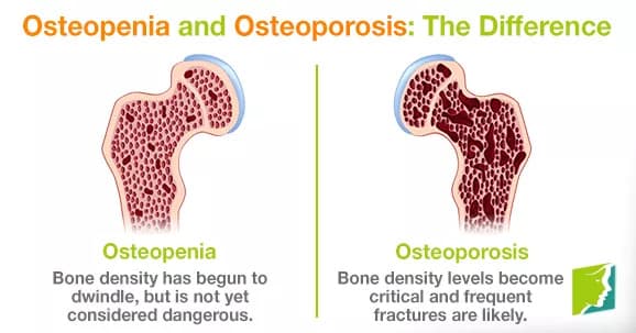 Osteoporosis vs Osteopenia — What's the Difference and What Should You Do?