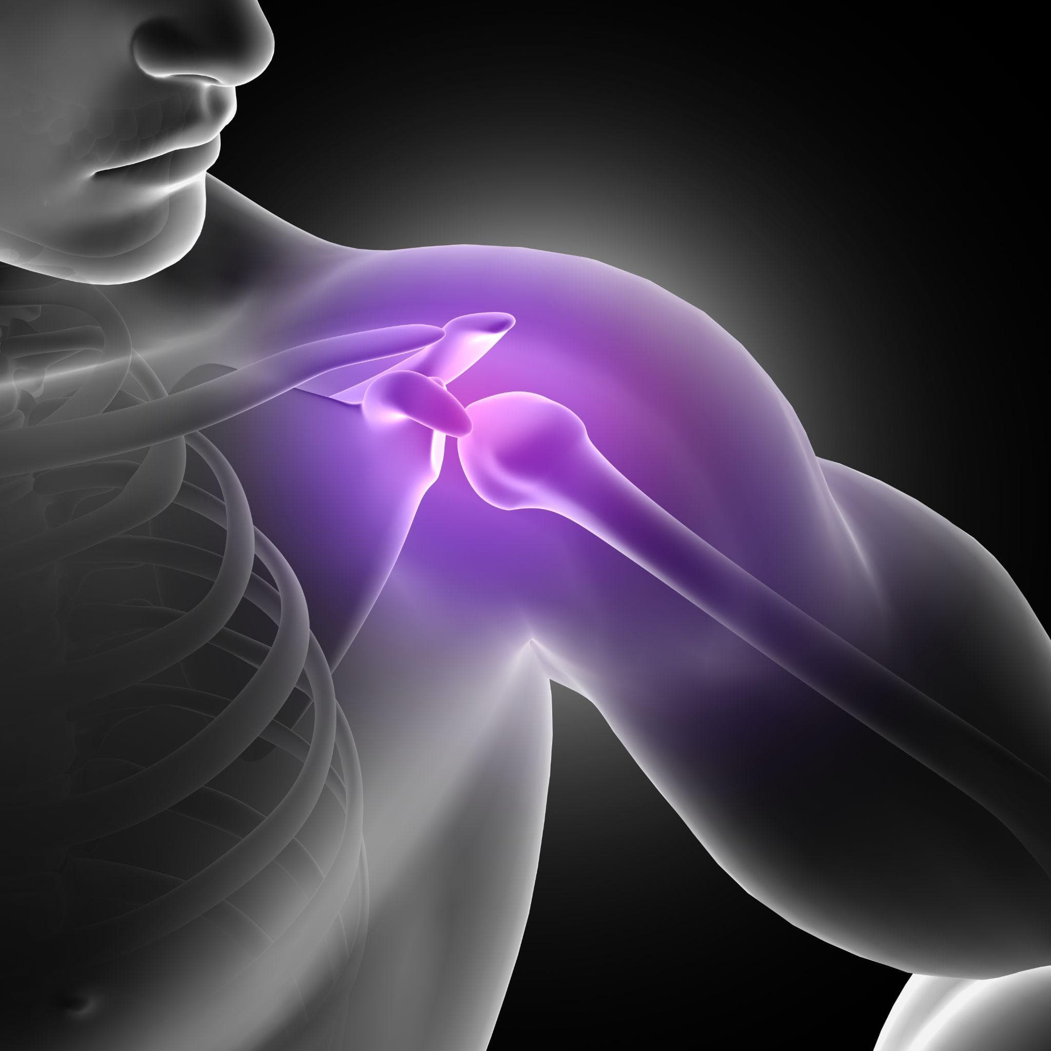 Reverse Shoulder Replacement - Who Needs It and How Is It Different?