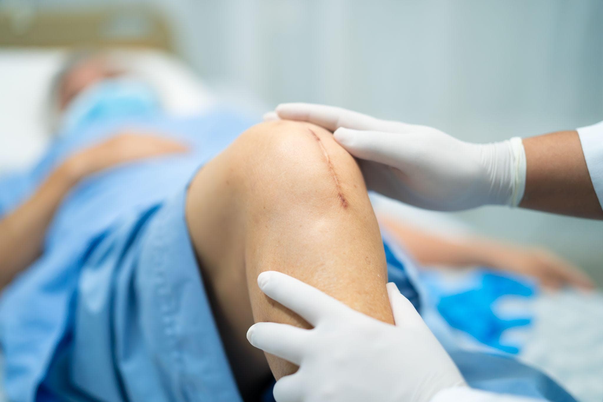 Robotic Knee Replacement Recovery Timeline - What To Expect Week By Week