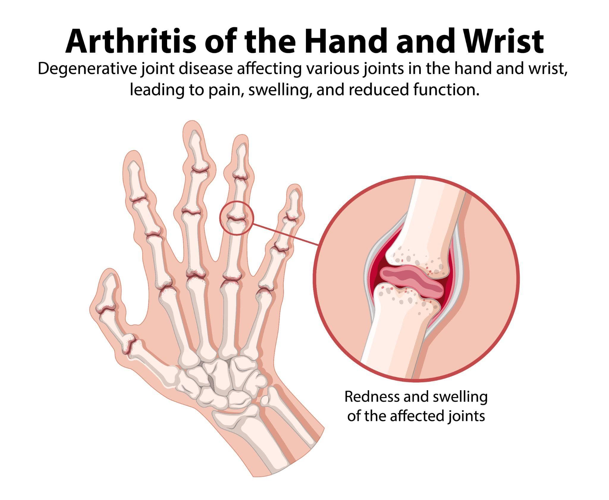 Rheumatoid Arthritis and Joint Replacement — When Surgery Becomes the Answer